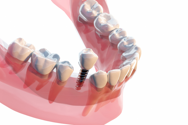 桶川（桶川市）の歯医者、のざき歯科のインプラント治療