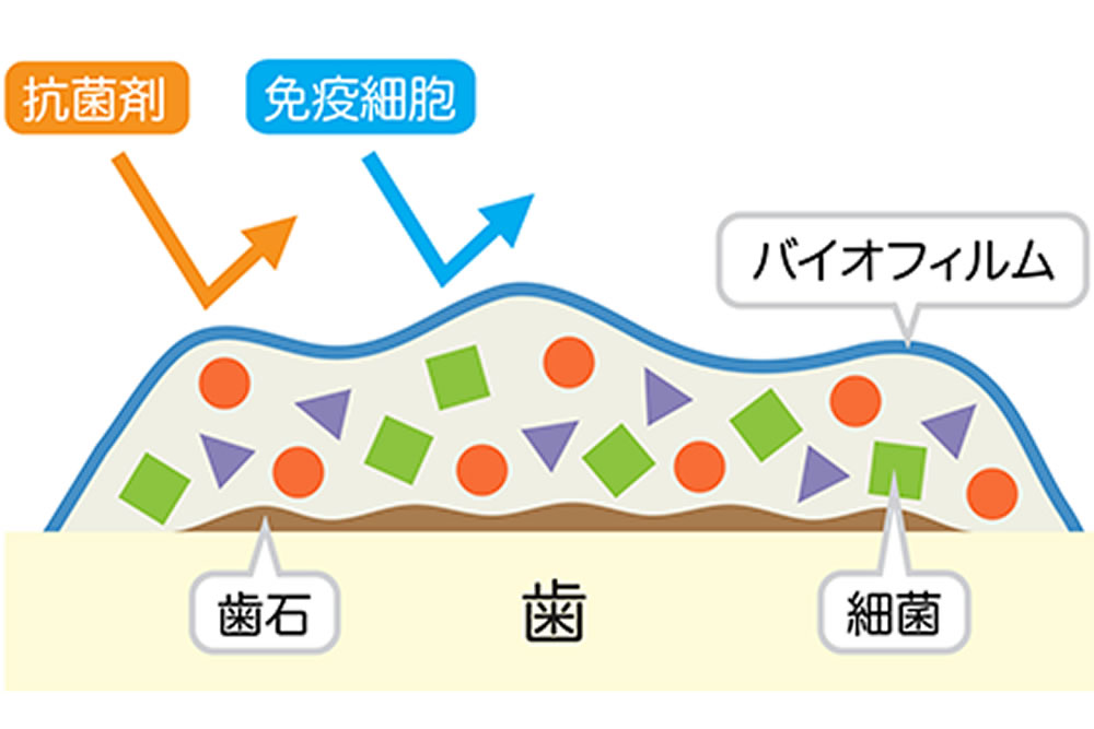 桶川（桶川市）の歯医者、のざき歯科で予防歯科