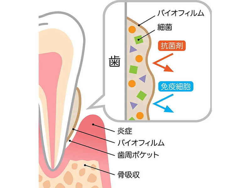 桶川（桶川市）の歯医者、のざき歯科で予防歯科