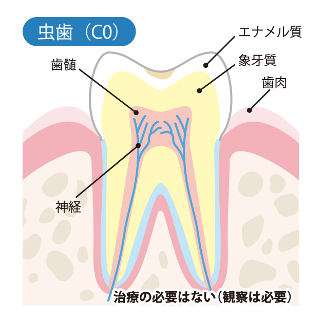 桶川（桶川市）の歯医者、のざき歯科で虫歯治療