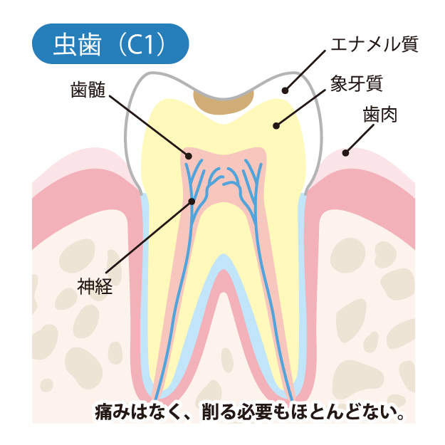 桶川（桶川市）の歯医者、のざき歯科で虫歯治療