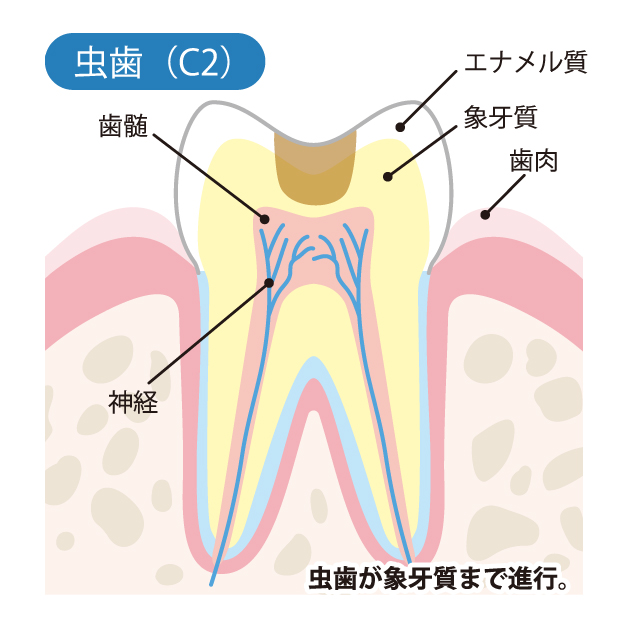 桶川（桶川市）の歯医者、のざき歯科で虫歯治療