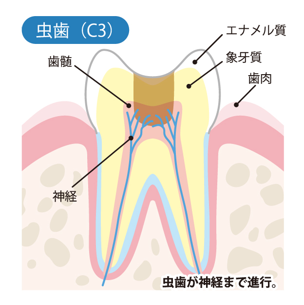 桶川（桶川市）の歯医者、のざき歯科で虫歯治療