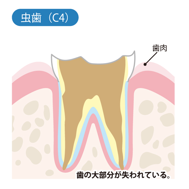 桶川（桶川市）の歯医者、のざき歯科で虫歯治療