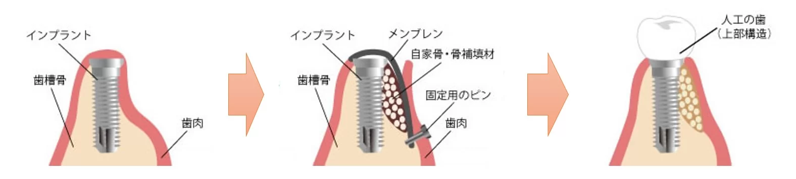 桶川（桶川市）の歯医者、のざき歯科のGBR法