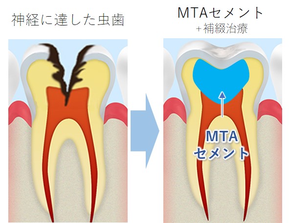 桶川（桶川市）の歯医者、のざき歯科のMTAセメント