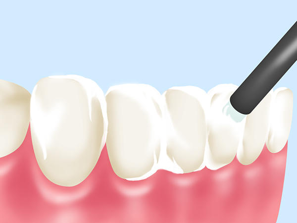 桶川（桶川市）の歯医者、のざき歯科でフッ素塗布