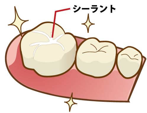桶川（桶川市）の歯医者、のざき歯科でシーラント