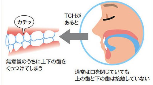 桶川（桶川市）の歯医者、のざき歯科で歯列接触癖対策